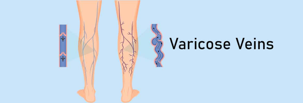 best varicose veins doctor